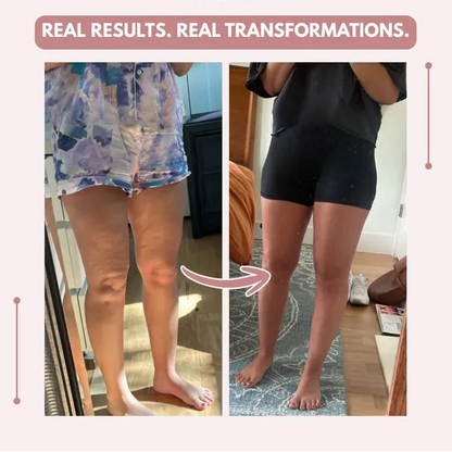 Mallas Venbelia 3D: Despídete de forma natural del dolor y la hinchazón del lipedema