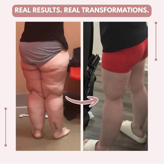 Mallas Venbelia 3D: Despídete de forma natural del dolor y la hinchazón del lipedema