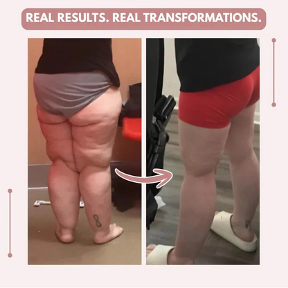 Mallas Venbelia 3D: Despídete de forma natural del dolor y la hinchazón del lipedema