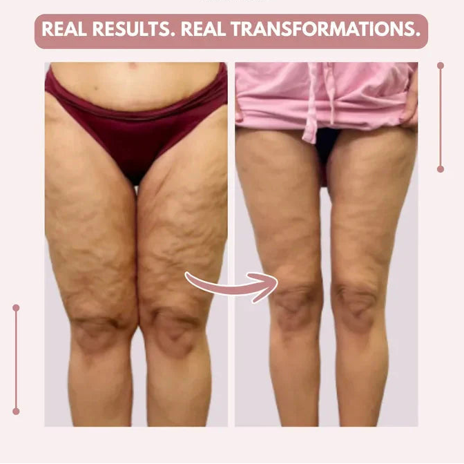 Mallas Venbelia 3D: Despídete de forma natural del dolor y la hinchazón del lipedema