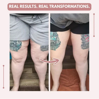 Mallas Venbelia 3D: Despídete de forma natural del dolor y la hinchazón del lipedema